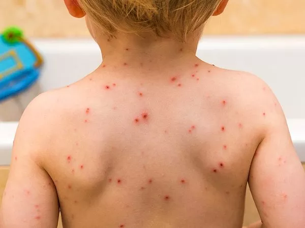 Çiçek hastalığı nedir? Çiçek hastalığı nedenleri nelerdir? Çiçek hastalığı nasıl bulaşır? Çiçek hastalığının belirtiler nelerdir? Çiçek hastalığı tedavisi nedir? Çiçek aşısı nedir? Çiçek aşısının yan etkileri nelerdir?