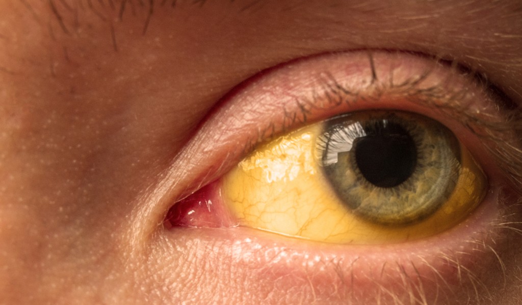 Sarı Nokta Hastalığı nedir? Sarı nokta hastalığının belirtileri nelerdir? Sarı nokta hastalığının nedenleri nelerdir? Sarı nokta hastalığının tedavisi nelerdir? Sarı nokta hastalığı ölümcül mü?