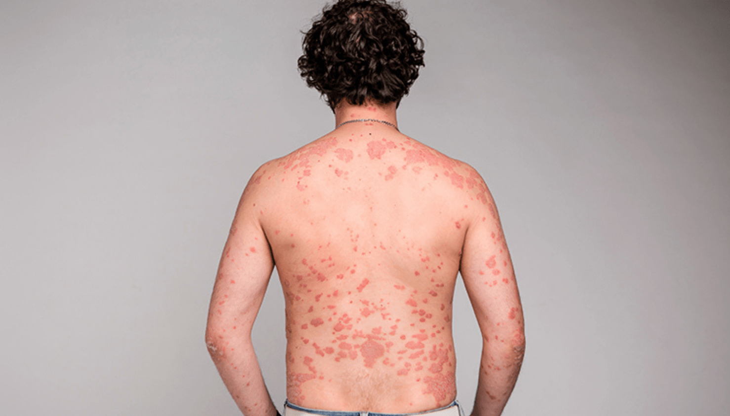 Sedef Hastalığı nedir? Sedef hastalığı bulaşıcı mıdır? Sedef hastalığı kimlerde görülür? Sedef hastalığının belirtileri nelerdir? Sedef hastalığı ölümcül müdür? Sedef hastalığı nasıl tedavi edilir? Sedef hastalığına sahip insanlara öneriler