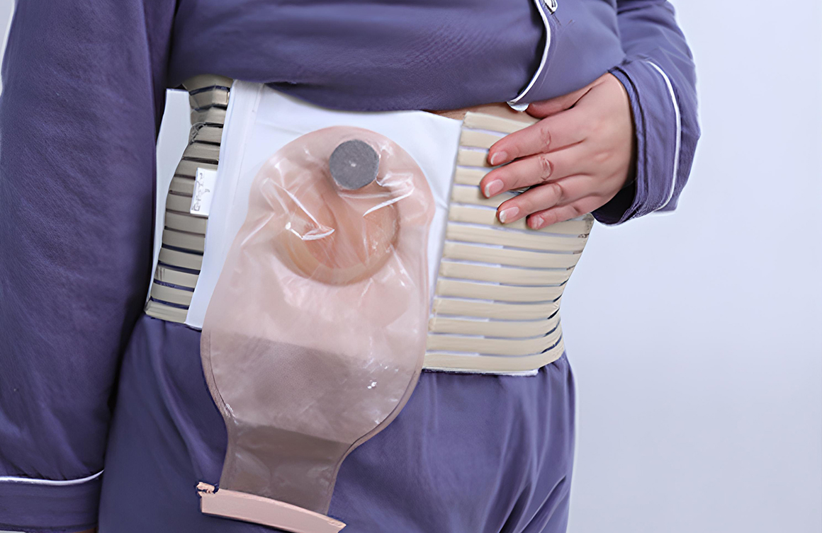 Stoma Nedir? Stomaya Neden İhtiyaç Duyulur? Stoma Çeşitleri Nelerdir? Stoma Hangi Durumlarda Tercih Edilir? Stomanın Özellikleri Stomanın Bazı Olası Komplikasyonları Nelerdir? Stoma Bakımı Nasıl Olmalı? Stoma Aparatı Değiştirme Sıklığı Nasıl Olmalıdır? Stoma Bakımında Kullanılan Cilt Bakım Ürünleri Nelerdir? Stoma ile Yaşamak Zor mudur?